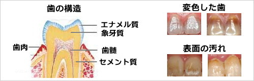 歯の変色原因 歯の変色原因