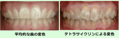 歯の変色 歯の変色
