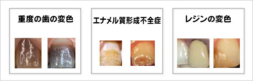 ホワイトニングの適応