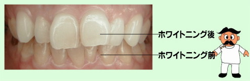 ホワイトニング